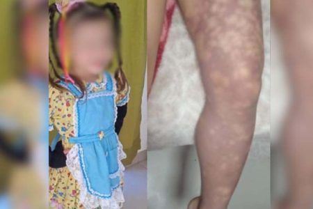 Três Barras: MP investiga caso de menina de 4 anos que teve perna amputada após receber injeção