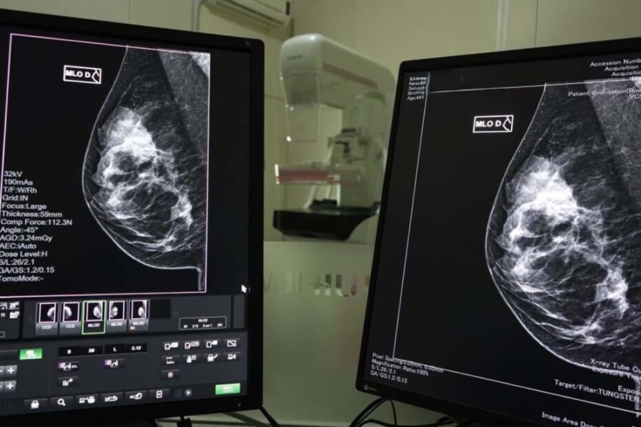 mamografia santa catarina hojesc