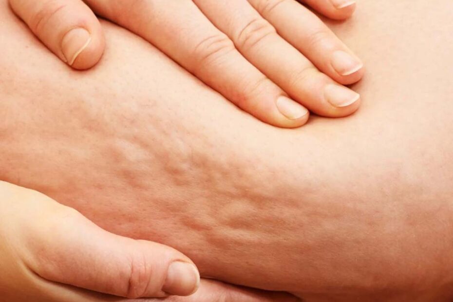 lipedema