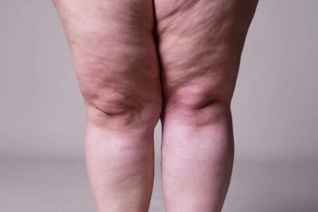 Lipedema: o que realmente ajuda no tratamento