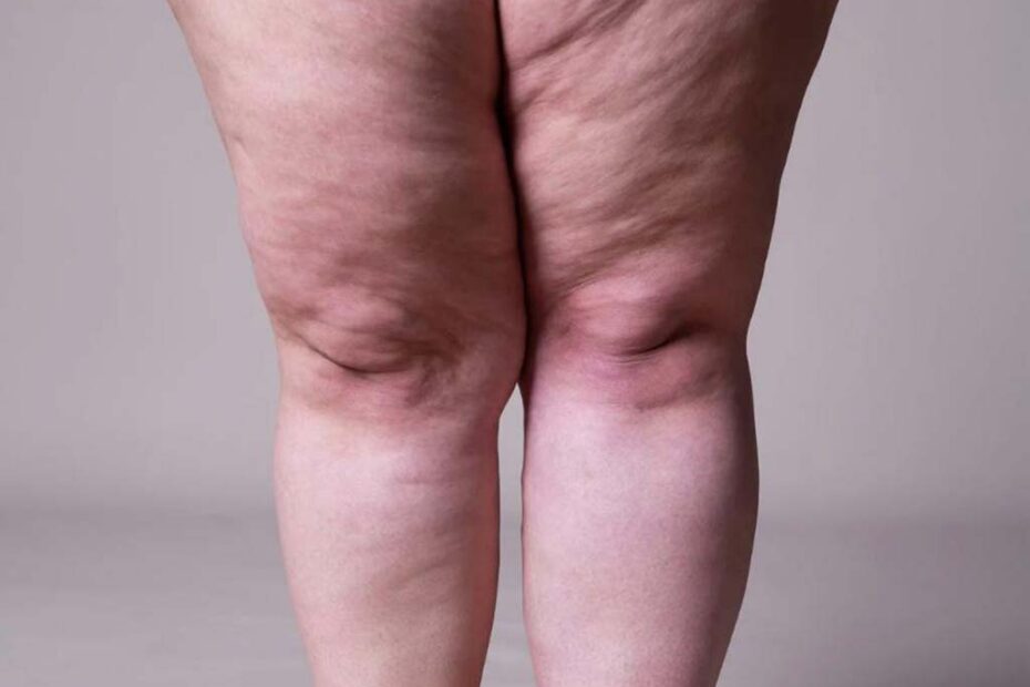Lipedema
